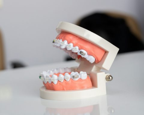 В-России-разработали-детали-брекетов-с-индикатором-налёта-на-зубах