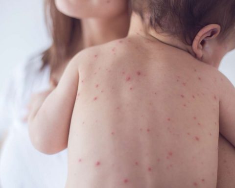 Учёные-предупредили-об-опасности-для-здоровья-альтернативных-методов-лечения-кори