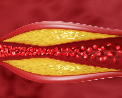 Физическая-активность-и-не-только:-вот-что-поможет-вам-при-высоком-уровне-холестерина