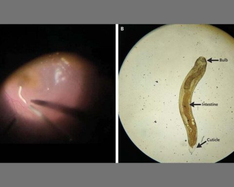 Из-за-паразита-мужчине-пришлось-высосать-стекловидное-тело-глаза