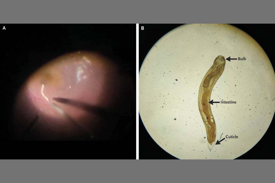 Из-за-паразита-мужчине-пришлось-высосать-стекловидное-тело-глаза
