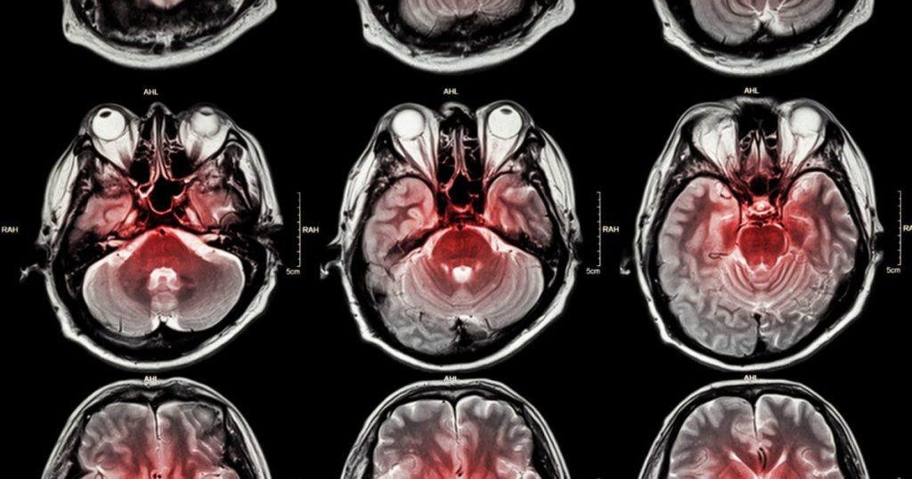 triglycerides,-blood-sugar,-weight-and-waist-volume:-what-factors-affect-the-risk-of-stroke