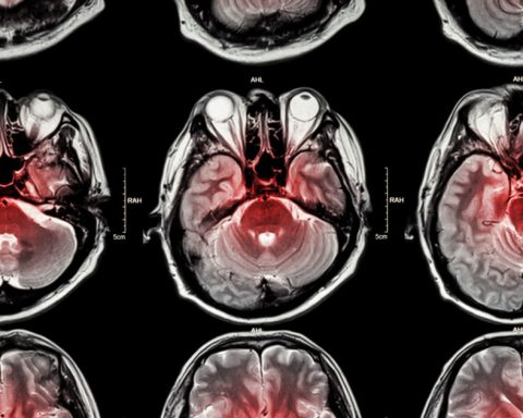 triglycerides,-blood-sugar,-weight-and-waist-volume:-what-factors-affect-the-risk-of-stroke